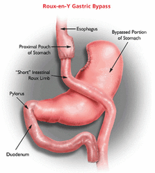 roux-en-y_gastric_bypass.gif